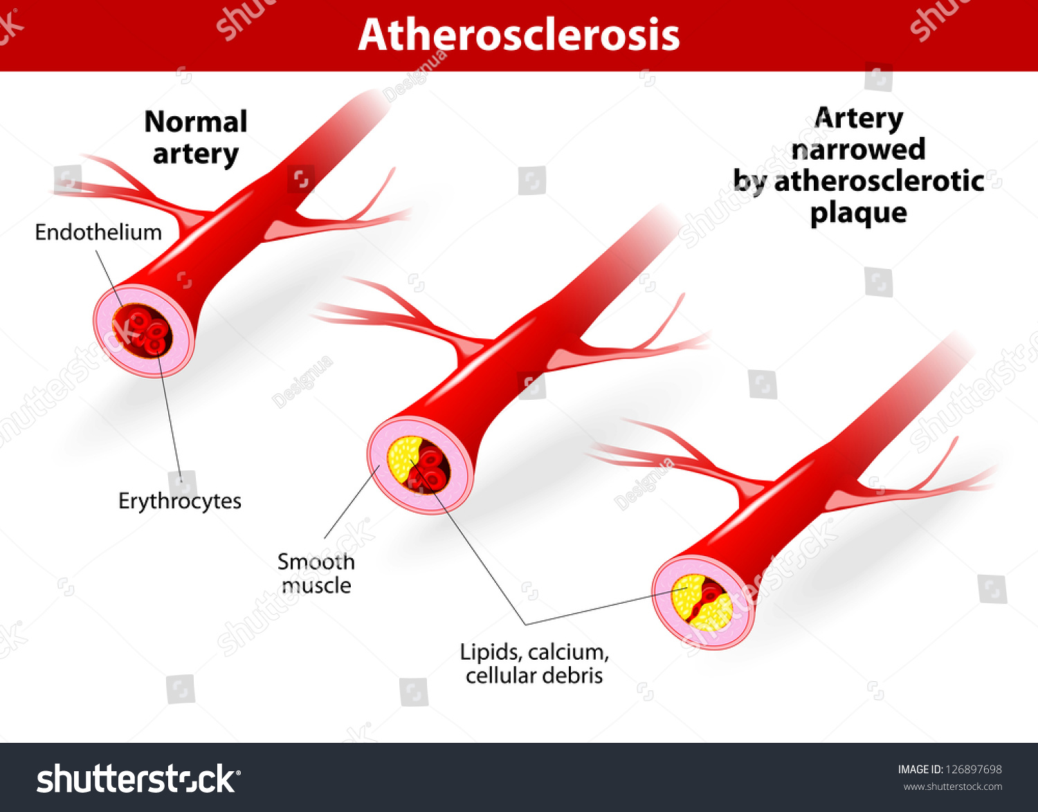 Vektor Stok Atherosclerosis Arteries Narrowed When Fatty Deposits