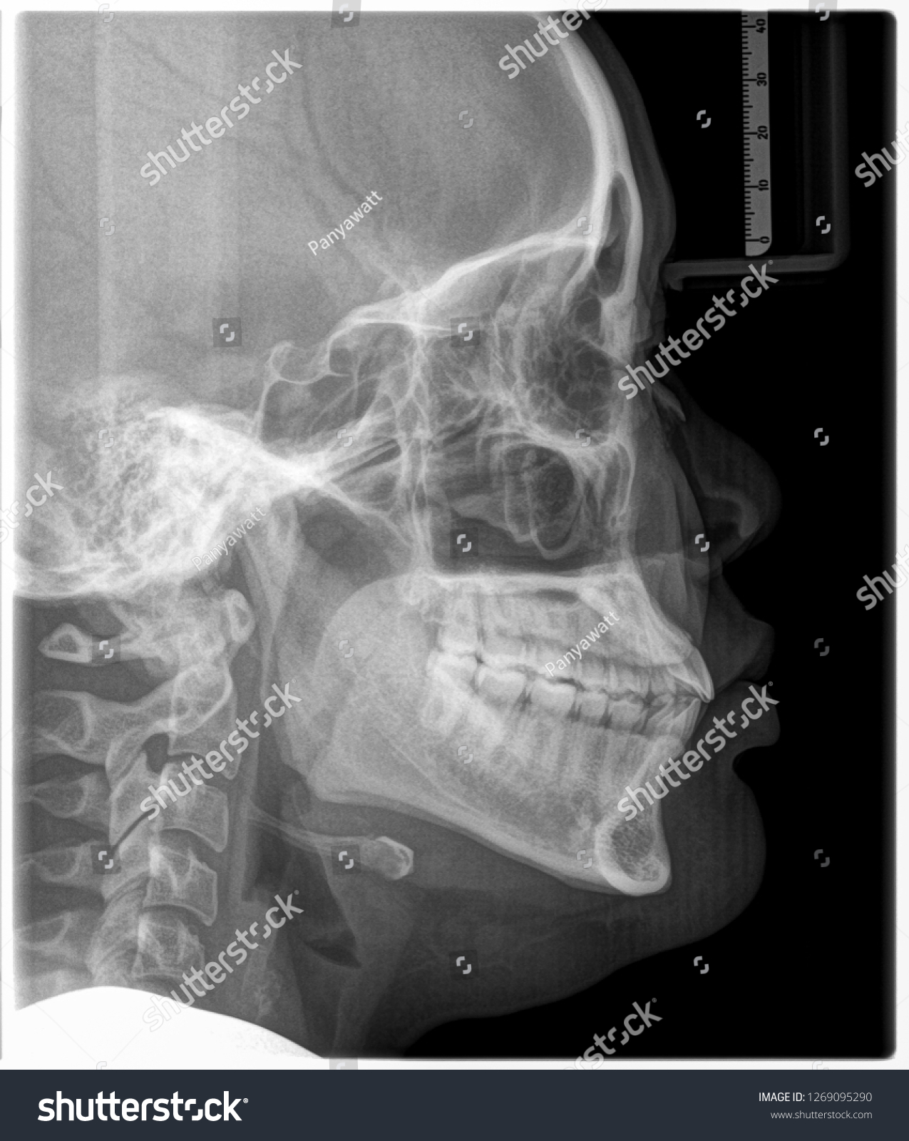 Xray Film Head Mouth Stock Photo 1269095290 | Shutterstock