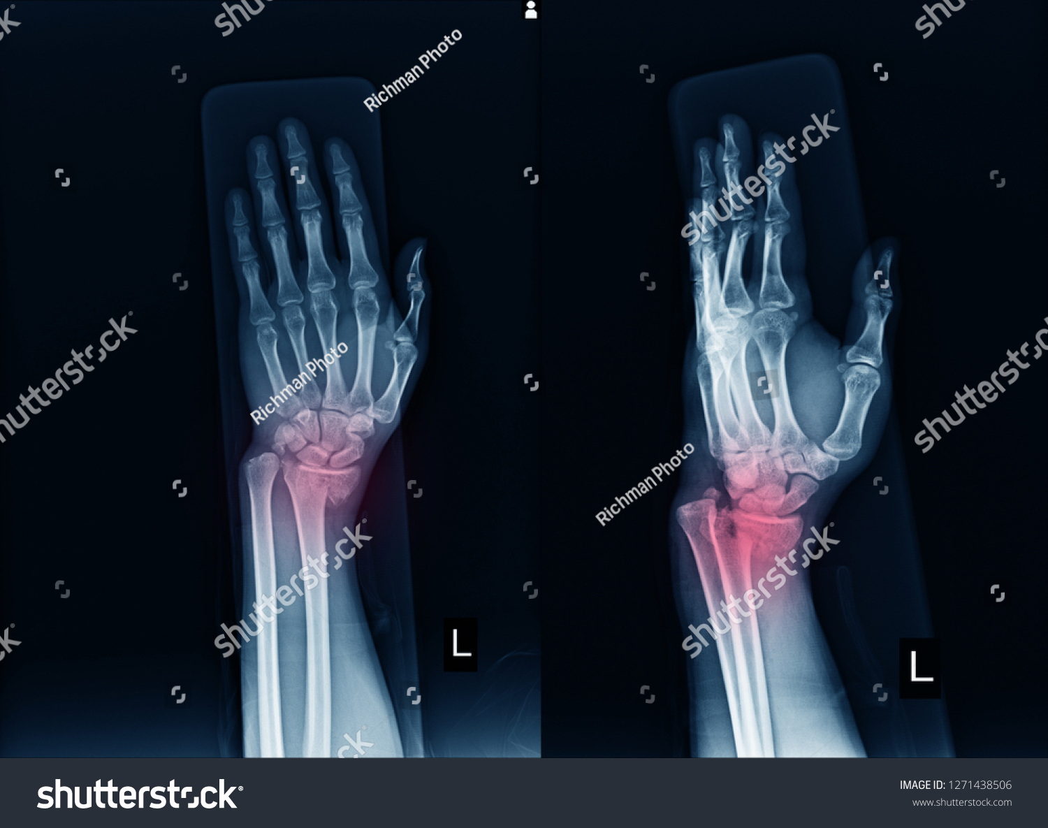 Xray Left Wrist Joint Aplateral Human Stock Photo 1271438506 | Shutterstock