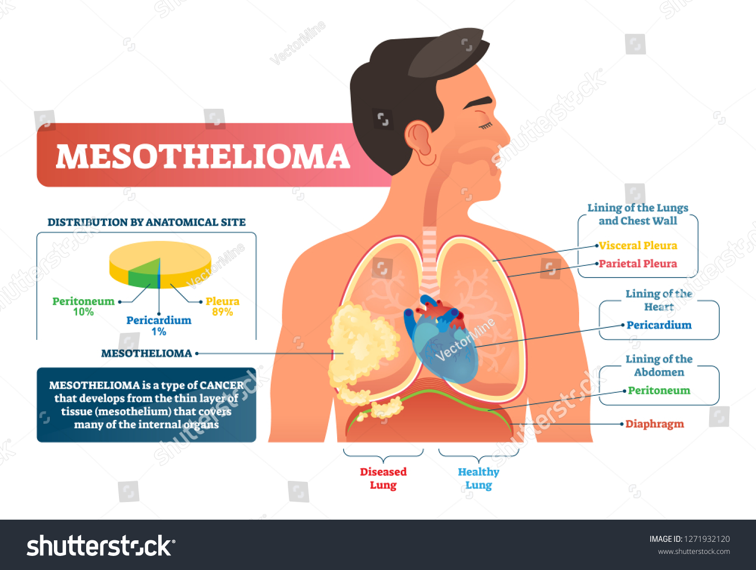 mesothelioma new lung