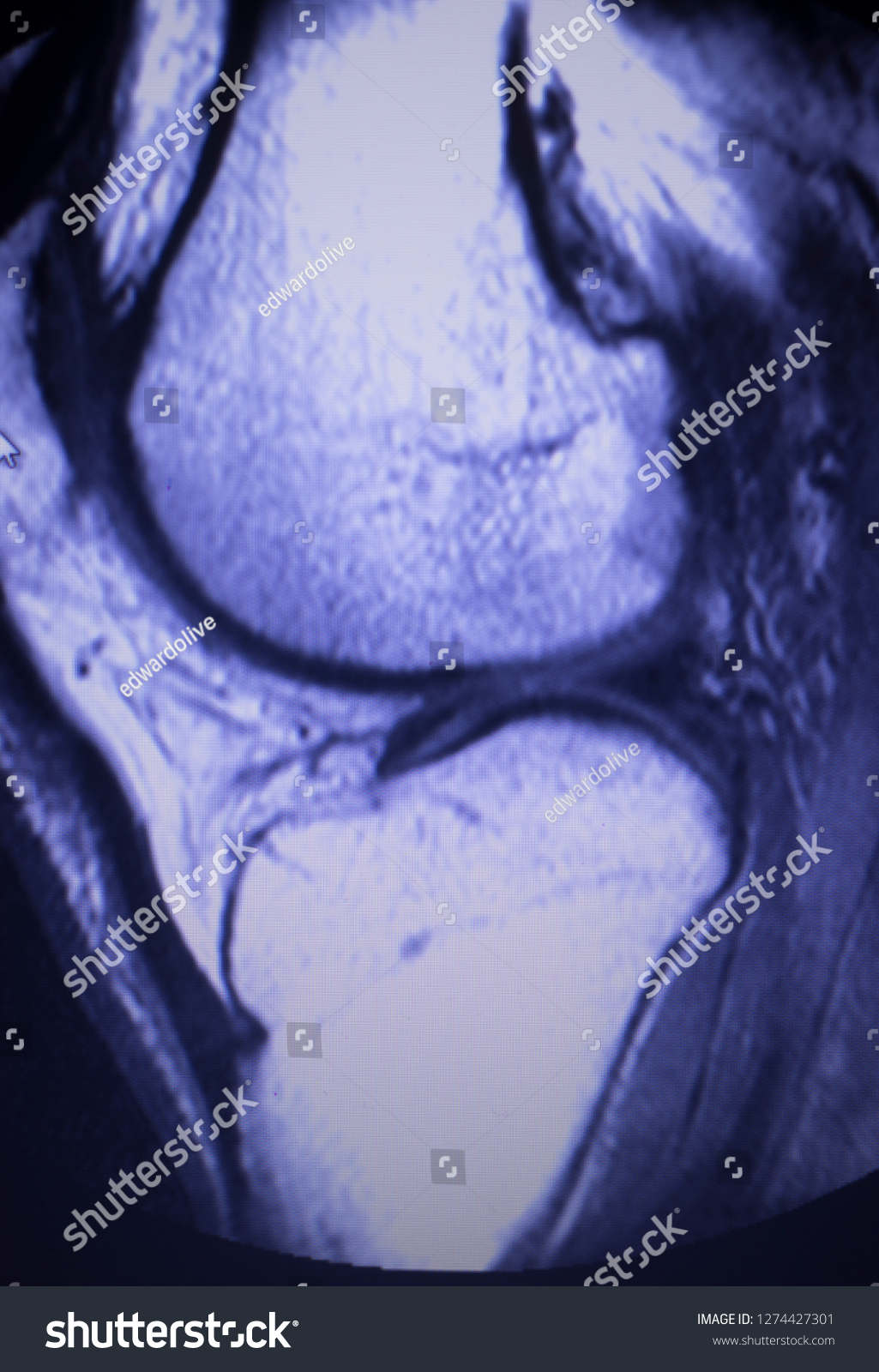 Magnetic Resonance Imaging Mri Knee Posterior Stock Photo 1274427301 ...