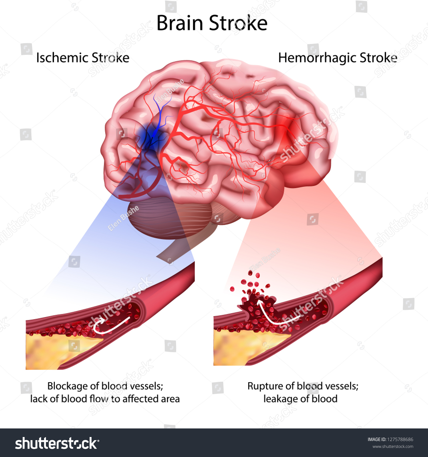 634,346 Stroke damage Images, Stock Photos & Vectors | Shutterstock