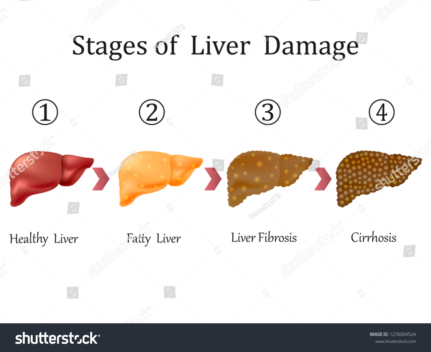 Vektor Stok Stages Liver Damage Liver Disease Healthy Tanpa Royalti