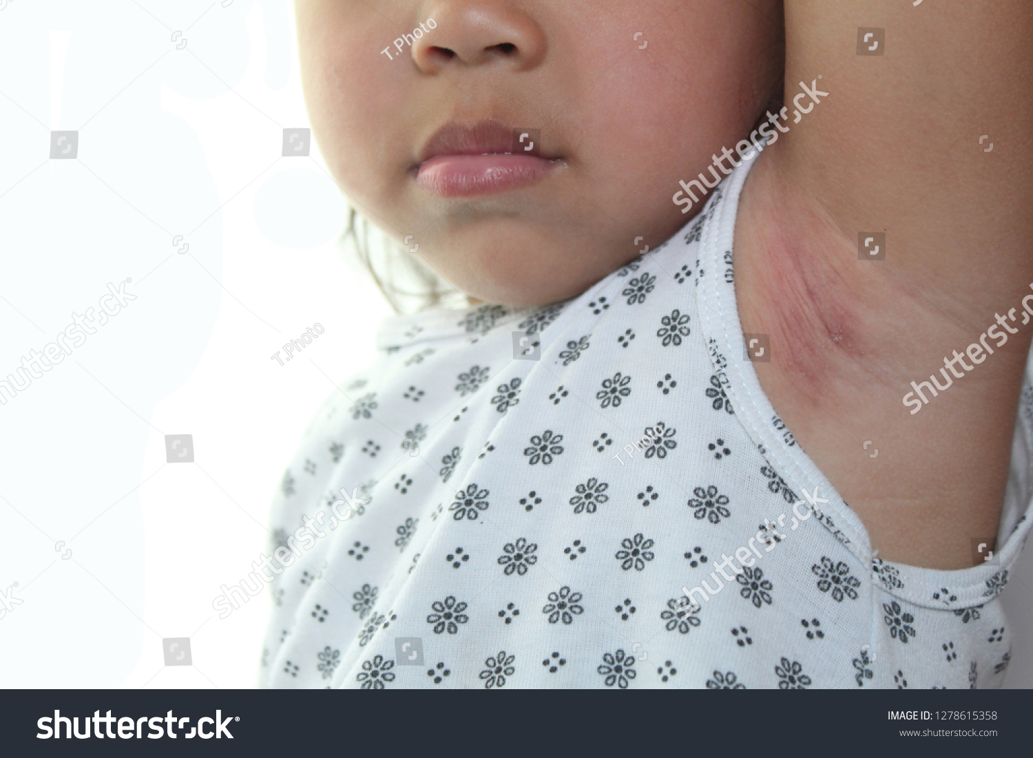 red-rash-armpit-area-children-stock-photo-1278615358-shutterstock