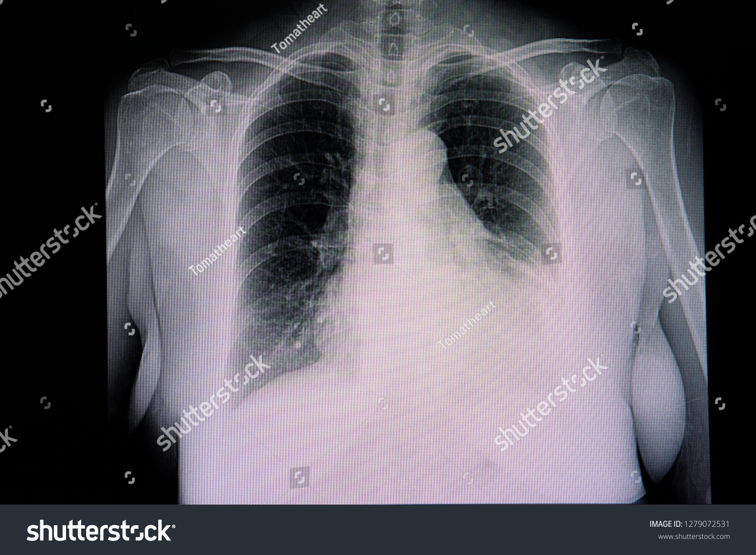 Chest Xray Film Patient Cardiomegaly Left Stock Photo 1279072531 ...