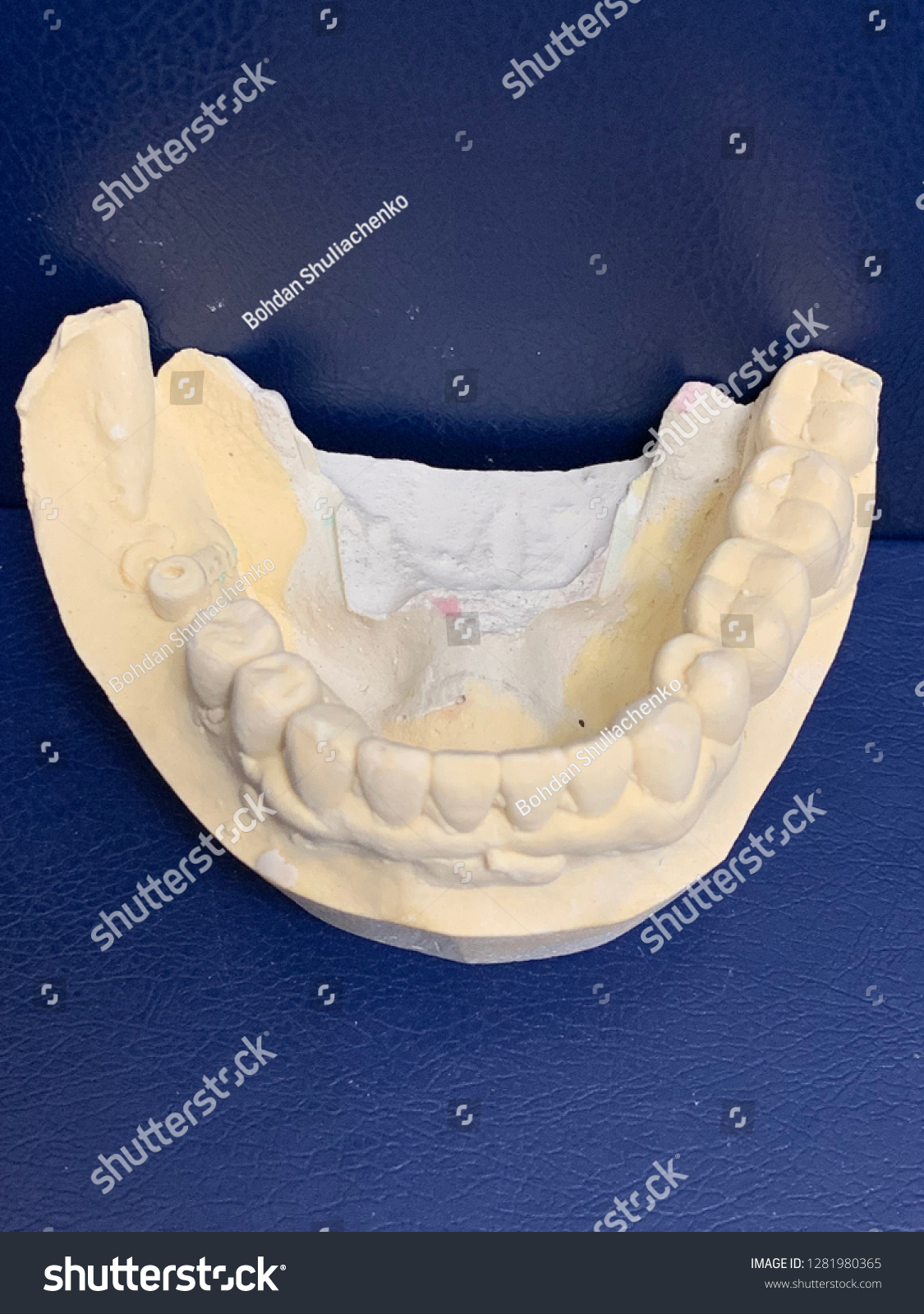 Dental Implants Bb Dental Laboratory Models Stock Photo 1281980365 ...