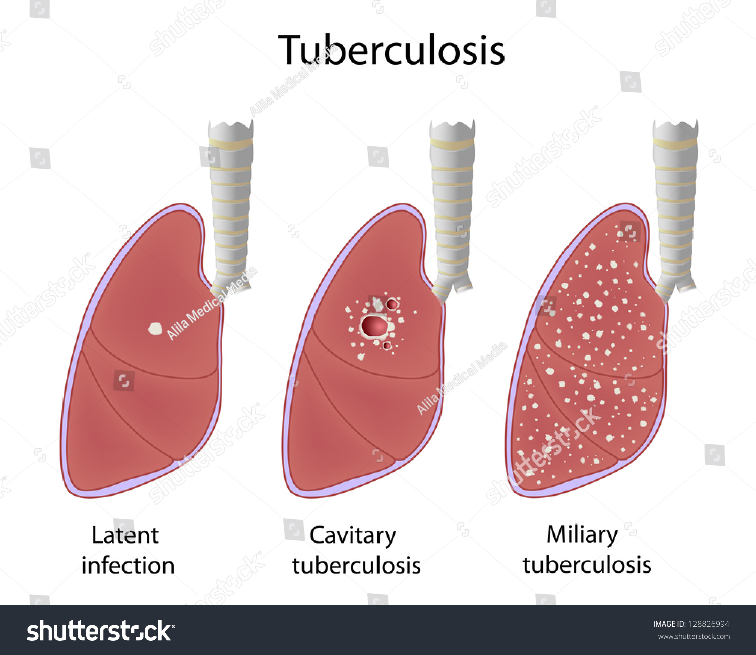 282 Types Tuberculosis Images, Stock Photos & Vectors | Shutterstock