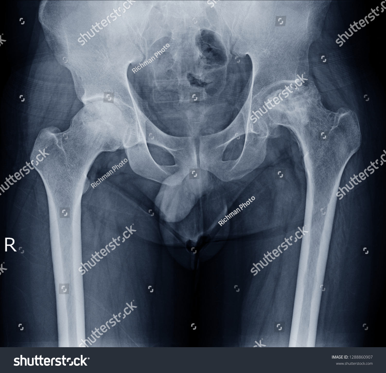 Остеопороз тазобедренного сустава рентген