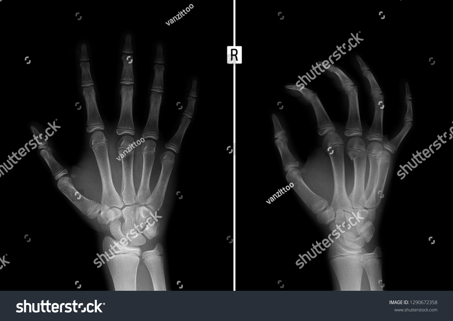 Xray Hand Fracture 3rd Metacarpal Bone Stock Photo 1290672358 ...