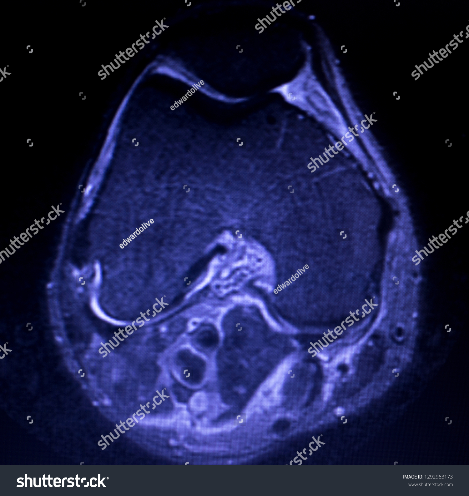 Magnetic Resonance Imaging Mri Knee Posterior Stock Photo 1292963173 ...