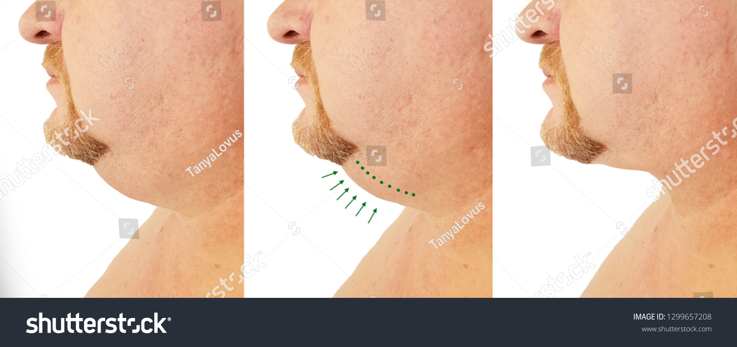 Submental Fat Man Before After Procedures Stock Photo 1299657208