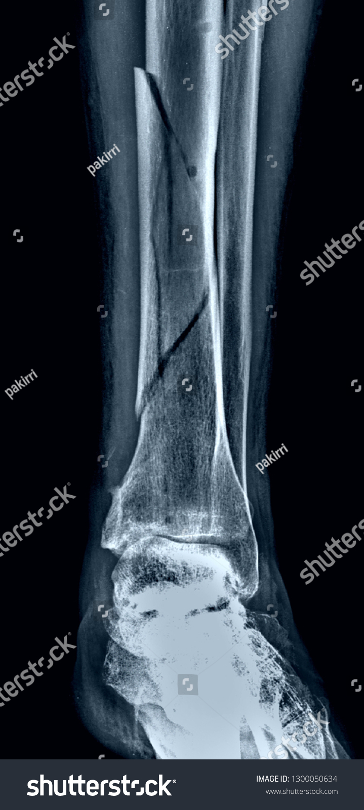 Radiography Fracture Tibia Fibula Stock Photo 1300050634 | Shutterstock