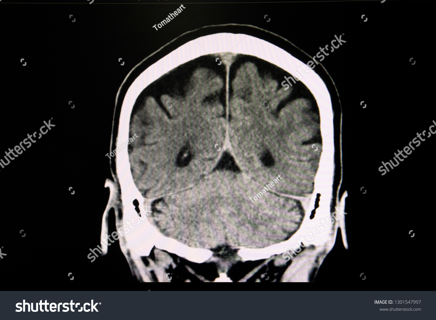 Ct Scan Brain Patient Suffers Acute Stock Illustration 1301547997 ...