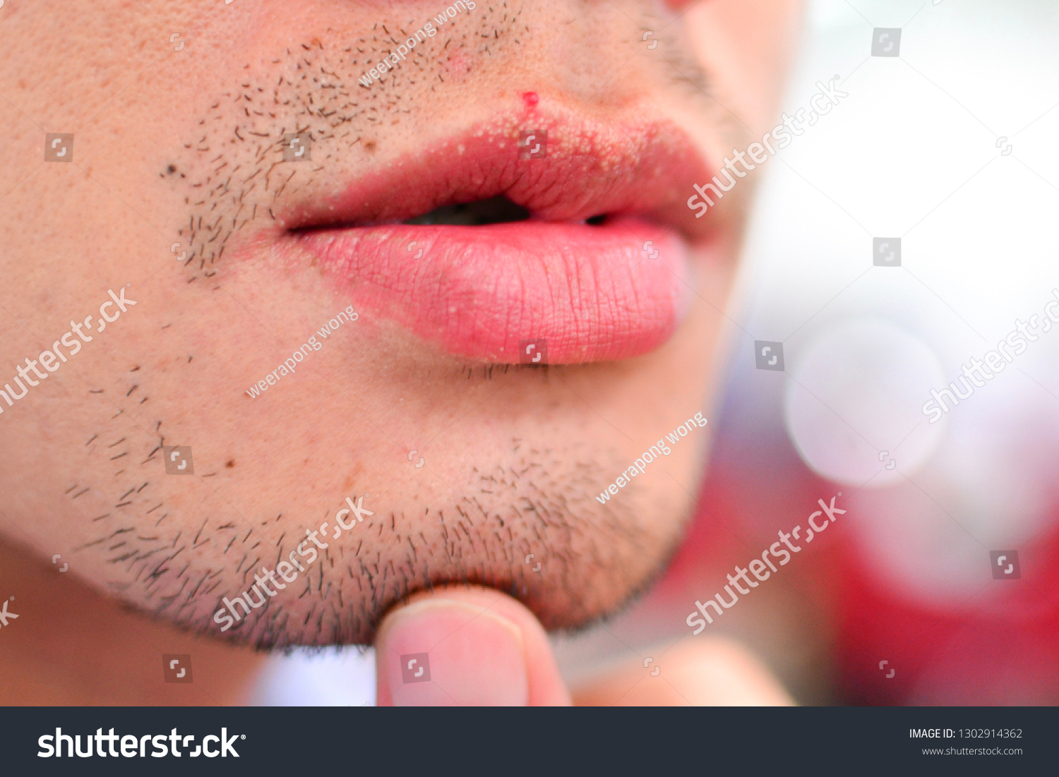 Fordyce Spots On Lips Stock Photo 1302914362 Shutterstock