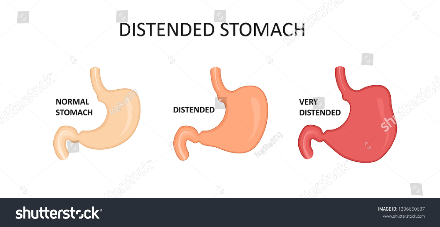 Types Stomachs Obesity Distended Stomach Stock Vector (Royalty Free ...