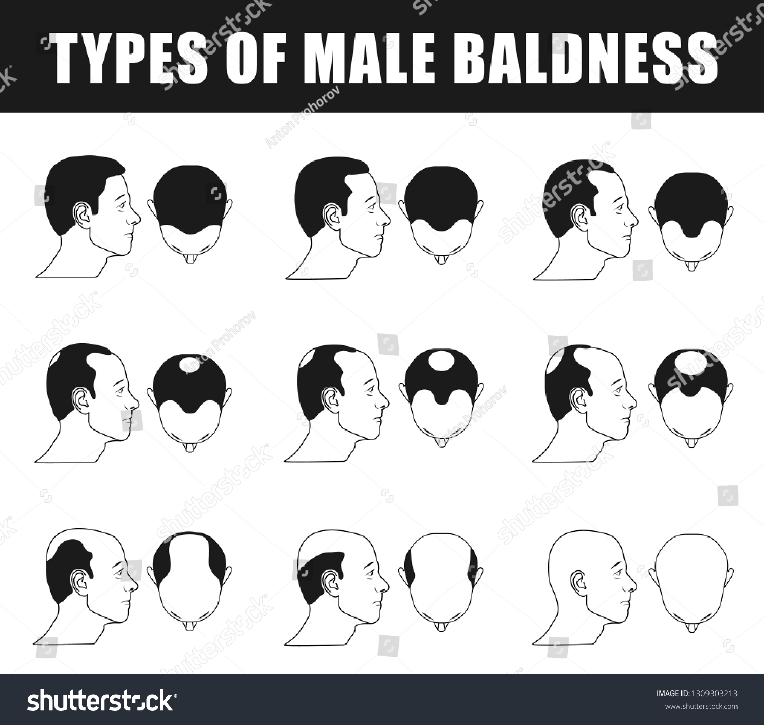 Types Male Baldness Icons Norwood Scale Stock Illustration 1309303213 ...