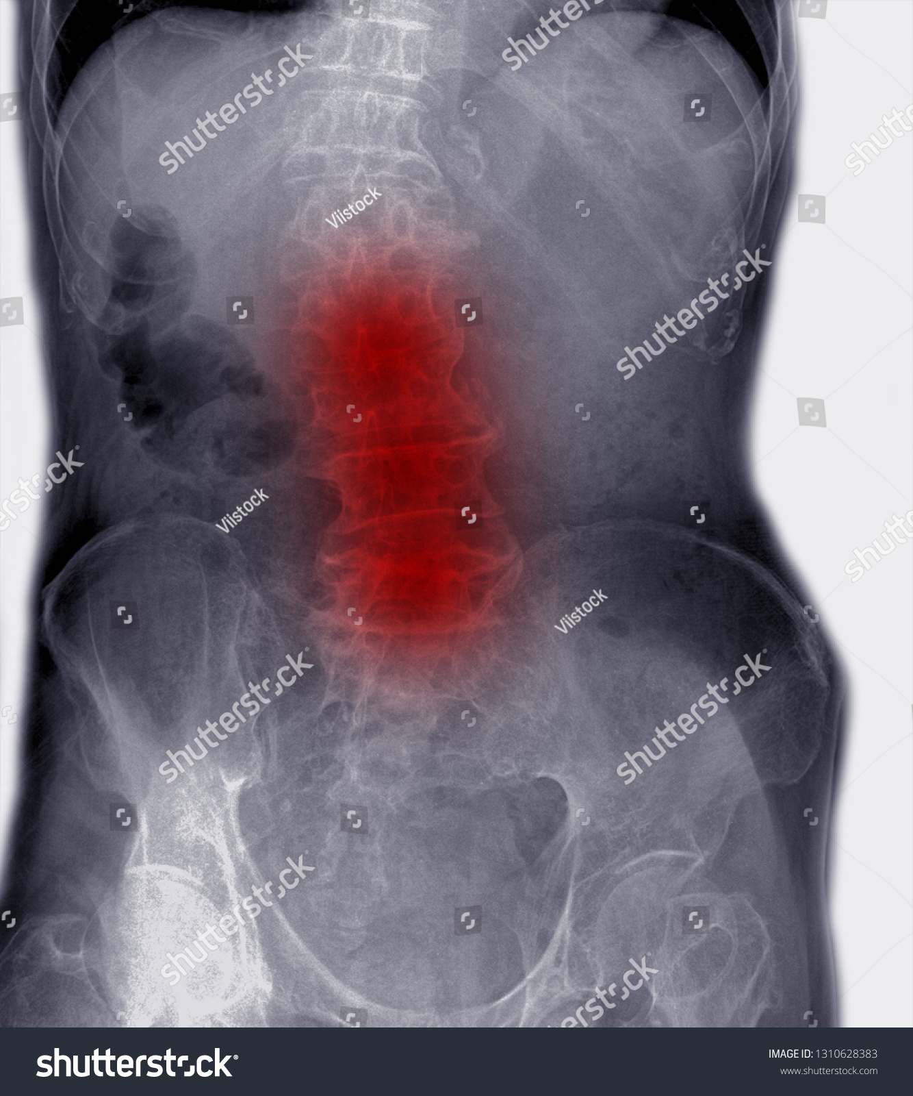 Film Xray Lumbar Spine Aging People Stock Illustration 1310628383 ...