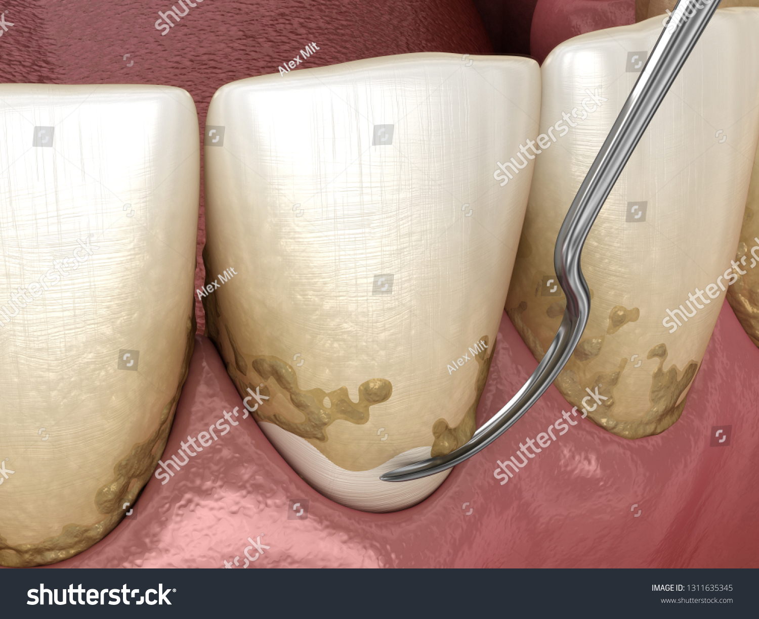 Oral Hygiene Scaling Root Planing Conventional Stock Illustration 1311635345 Shutterstock 3160