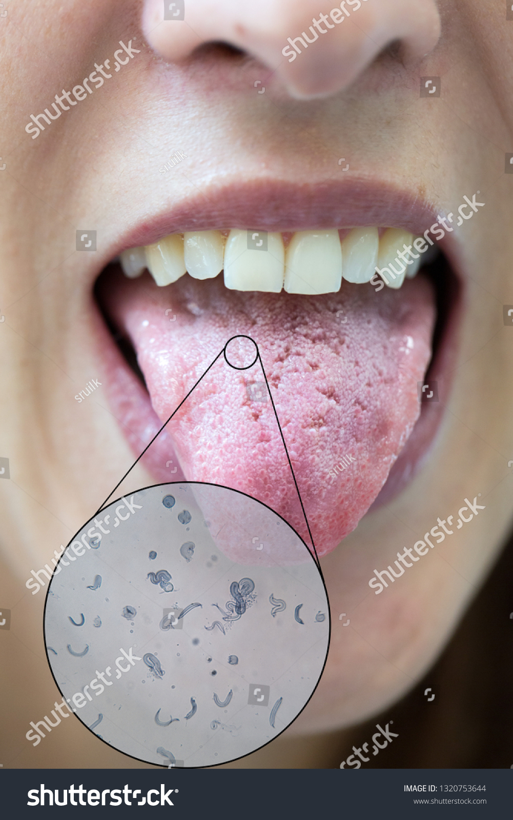Tongue Cracks Bacterial Infection Microscopic View 스톡 사진 1320753644 Shutterstock 7150