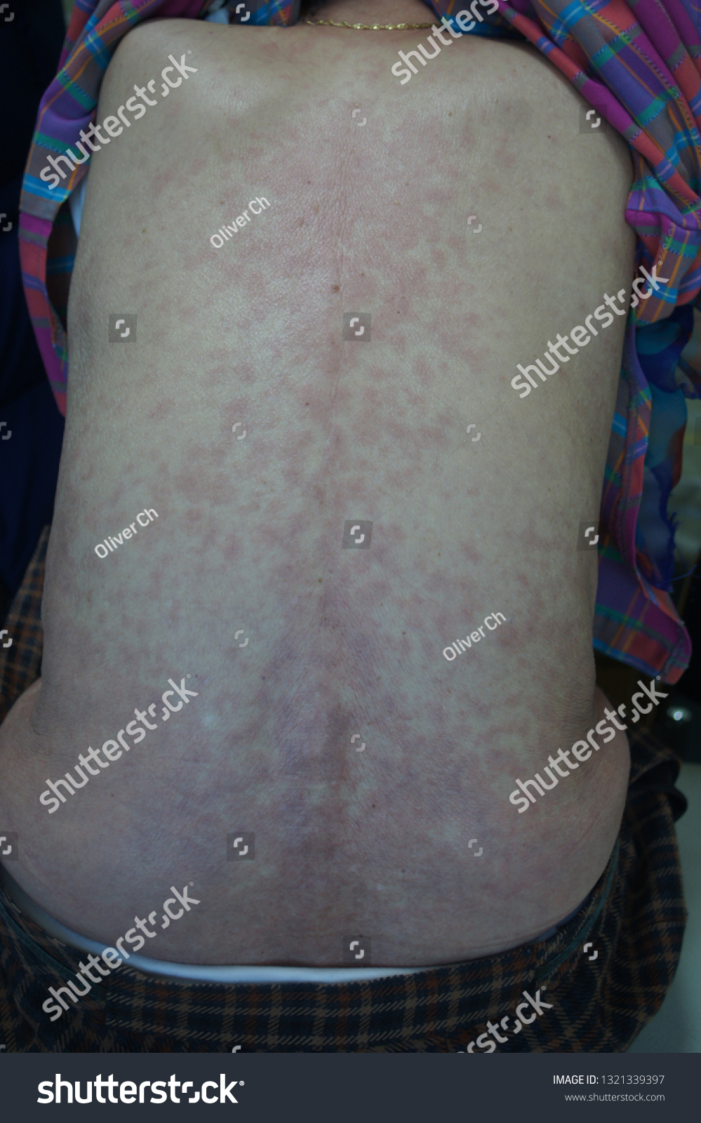 Drug Eruption Maculopapular Rash Foto Stok 1321339397 Shutterstock