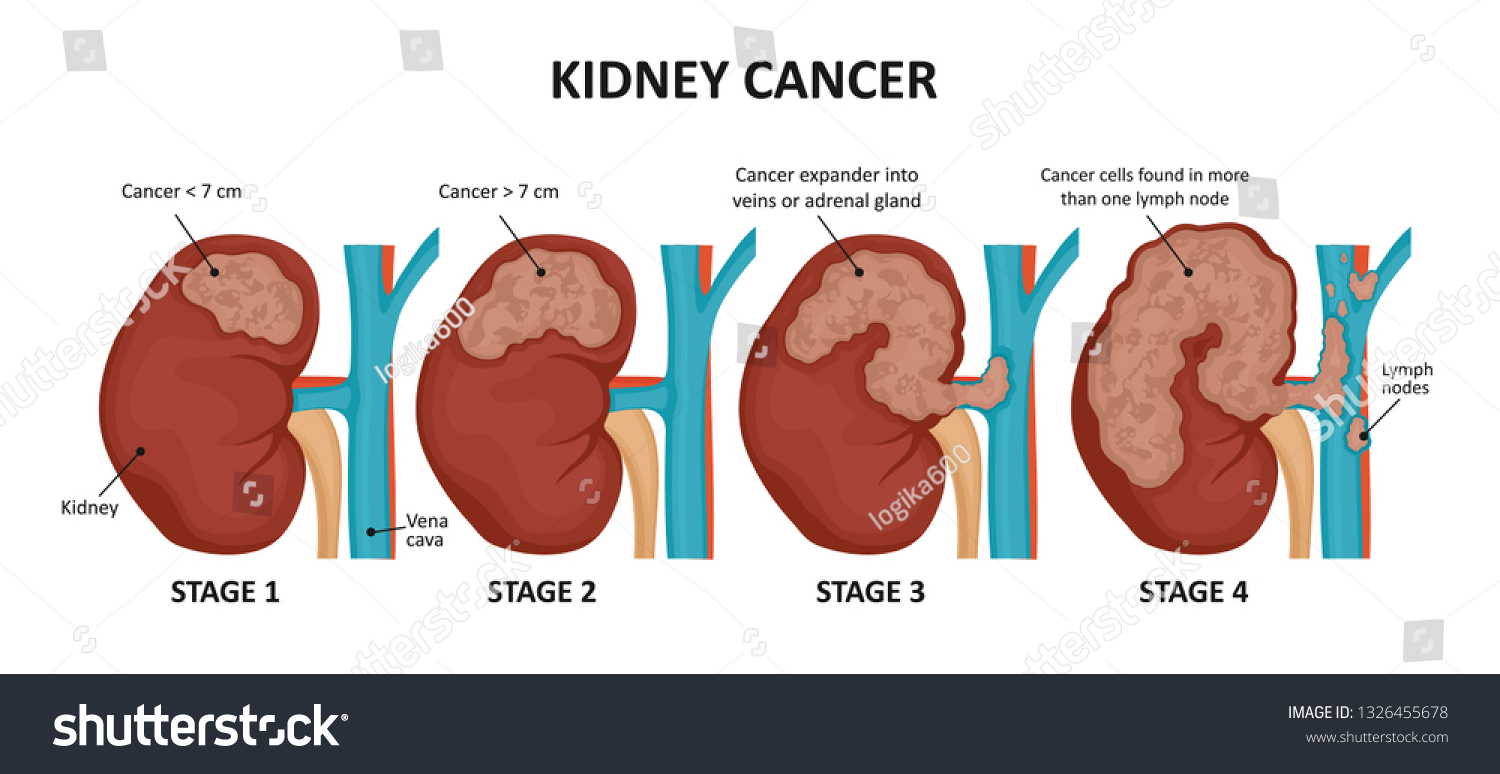 Kidney Cancer Stages Malignant Tumor Kidney Stock Vector (Royalty Free ...