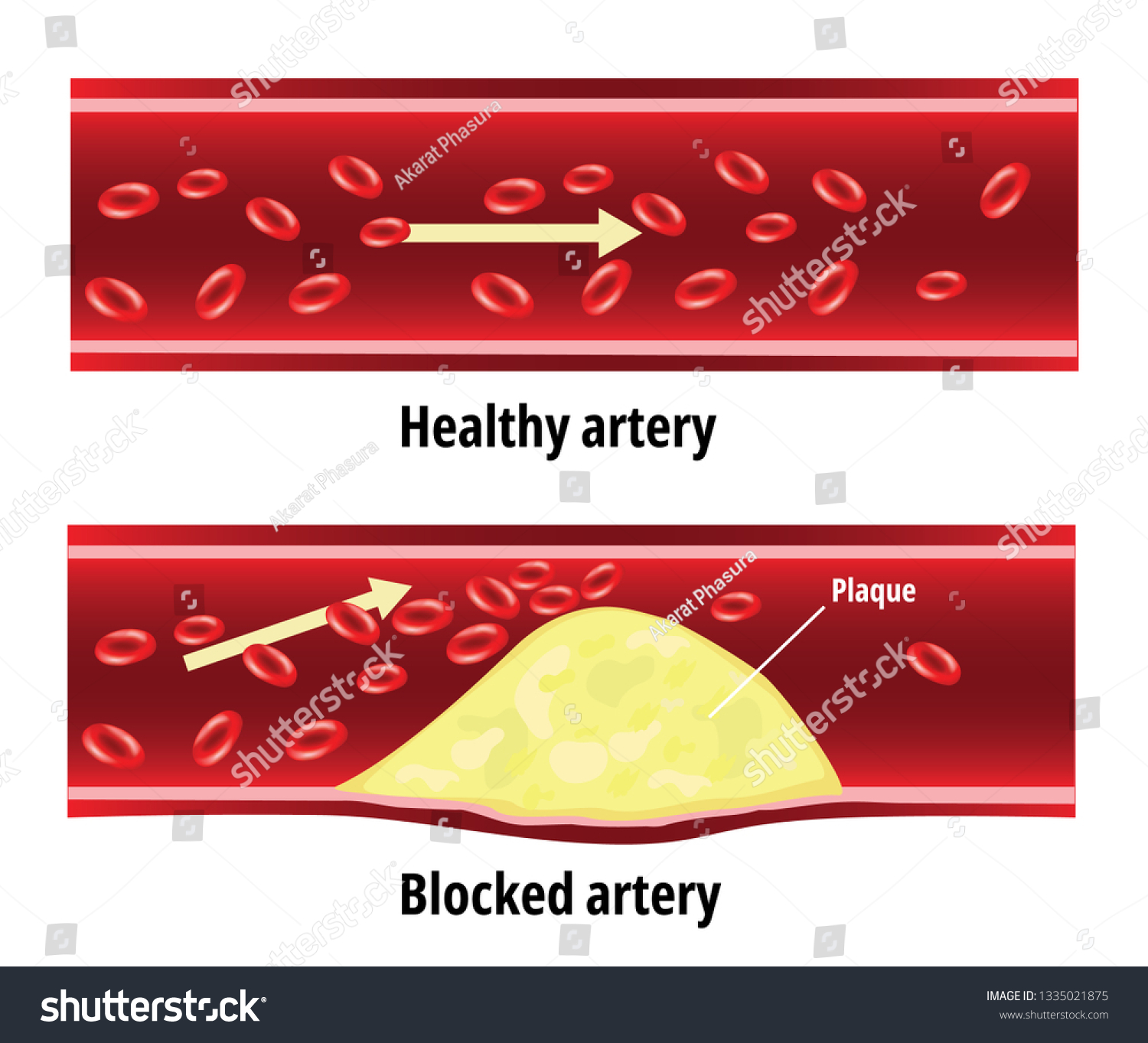 Blocked Artery Fat Stuck Blood Artery Stock Vector (Royalty Free ...