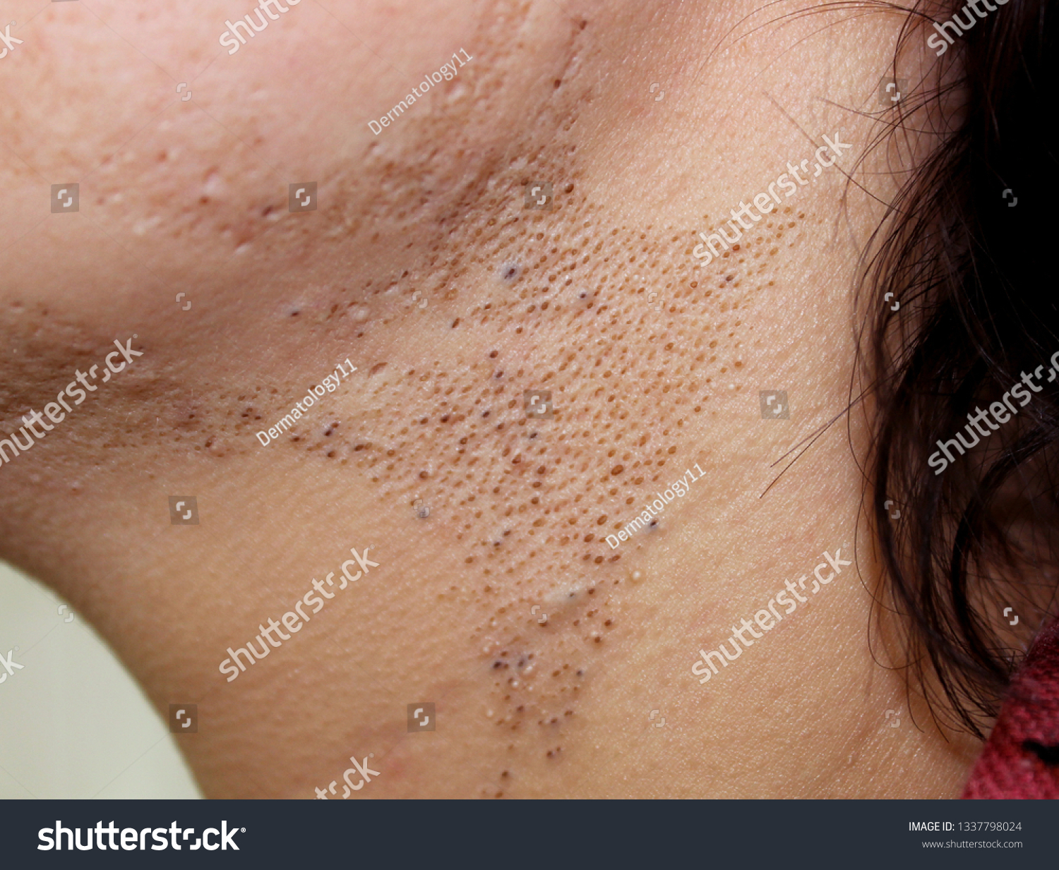 Case Segmental Nevus Comedonicus Comedo Nevus Stock Photo 1337798024 ...