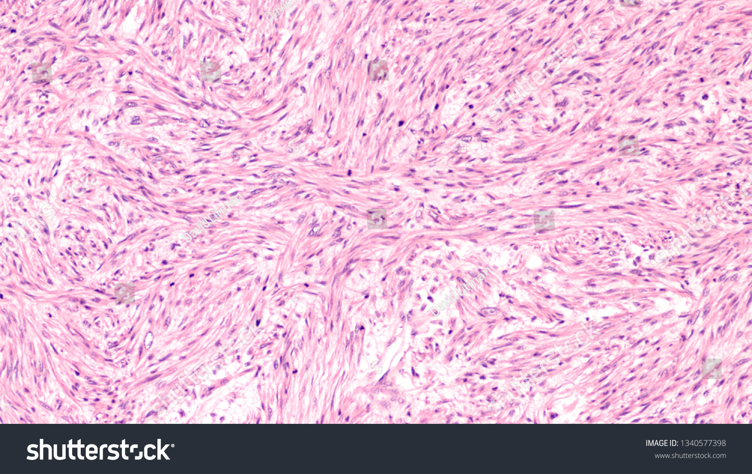 Microscopic Image Leiomyosarcoma Type Soft Tissue Stock Photo ...