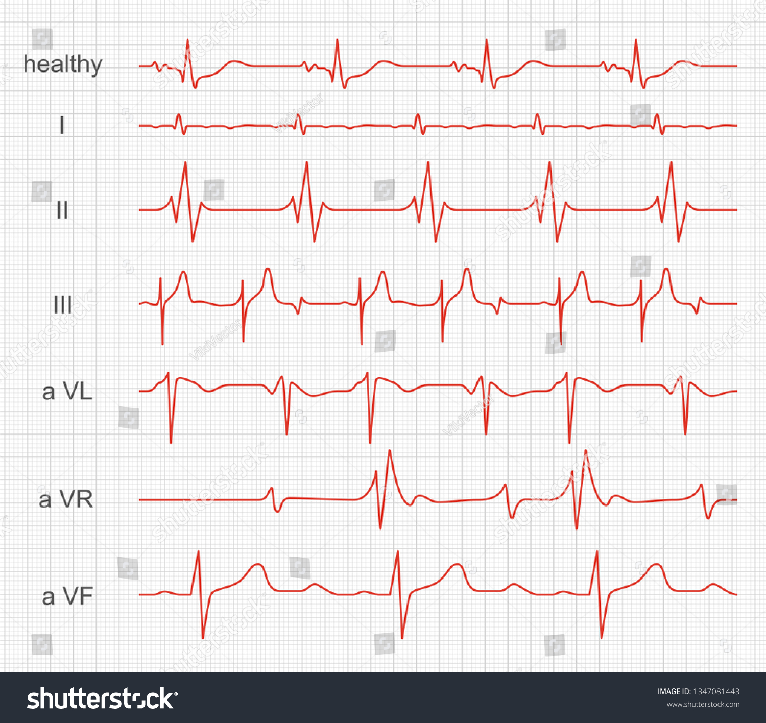 Cardiogram Heart Red Rhythm On Monitor Stock Vector (Royalty Free ...