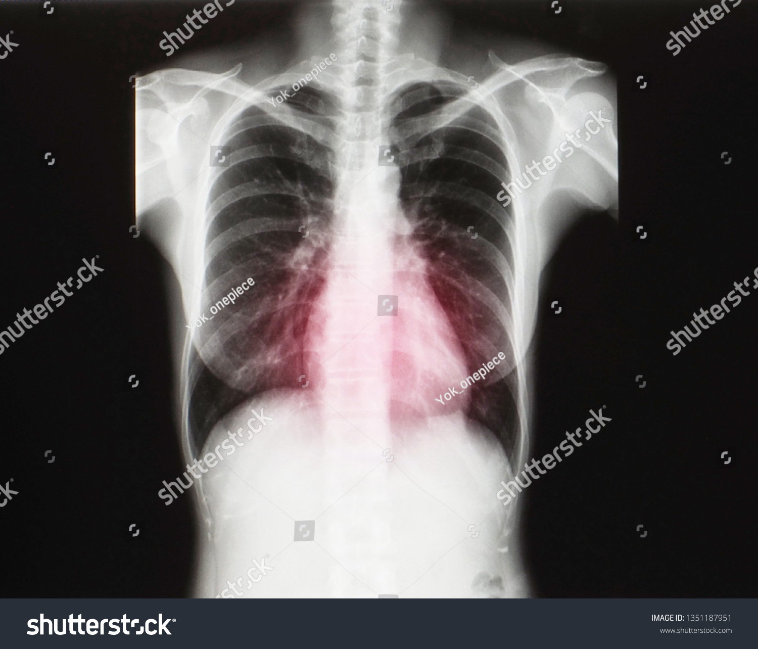 Anteroposterior Xray Radiograph Chest Heart Showing Stock Photo ...