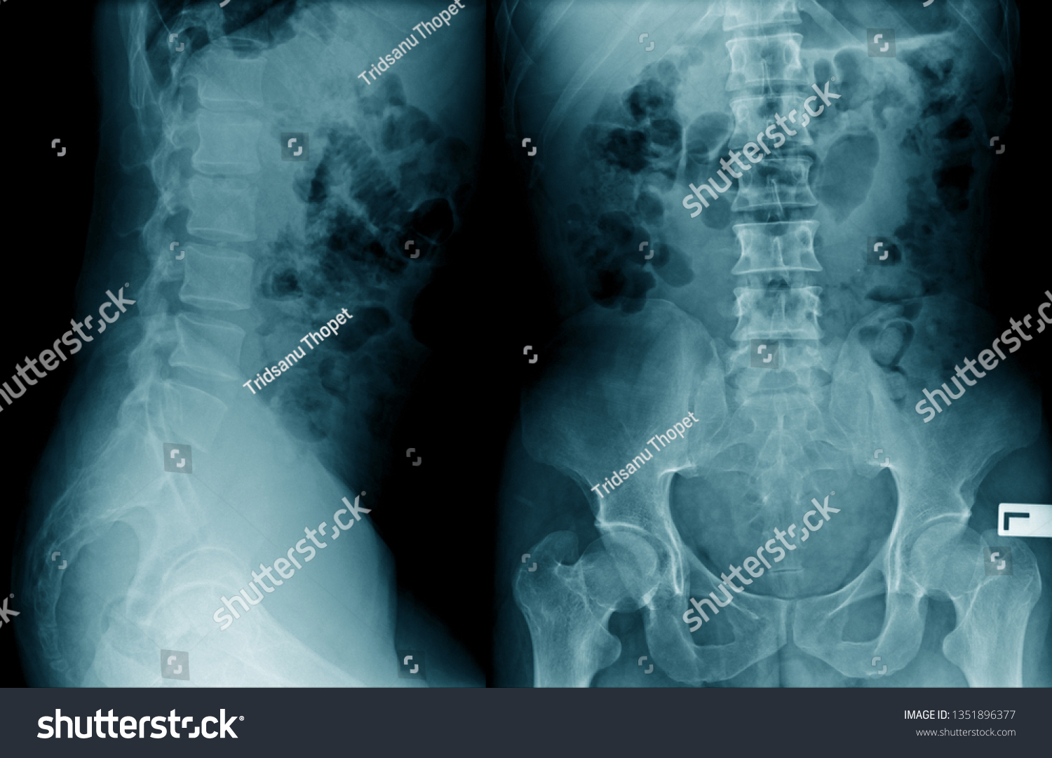 Lumbar Spondylosis Xray Image Ap Lateral Stock Photo 1351896377 ...