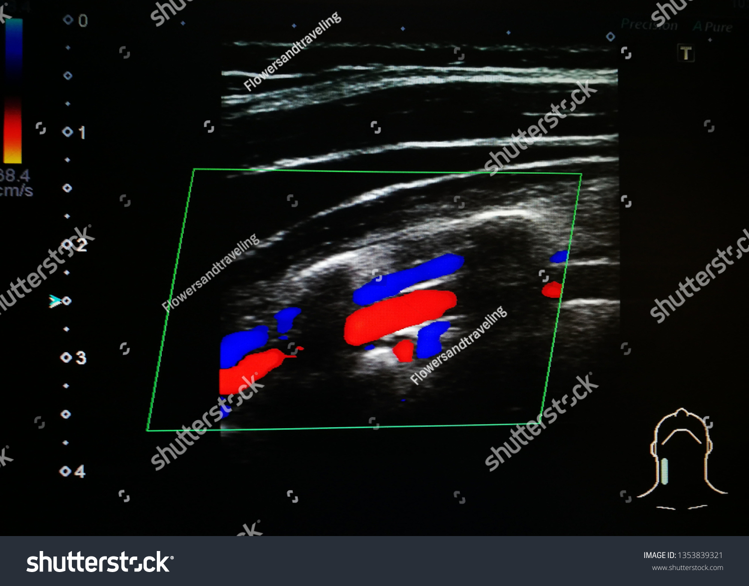 Color Doppler Ultrasound Vertebral Artery Vein Stock Photo 1353839321 ...