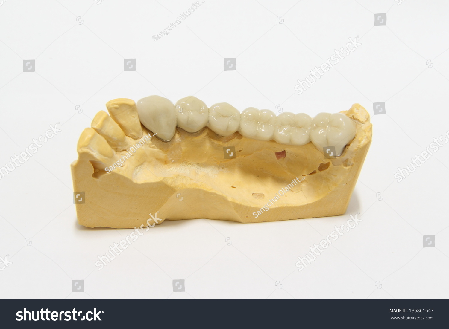 Finished Model Posterior Dental Bridge Long 스톡 사진 135861647 | Shutterstock