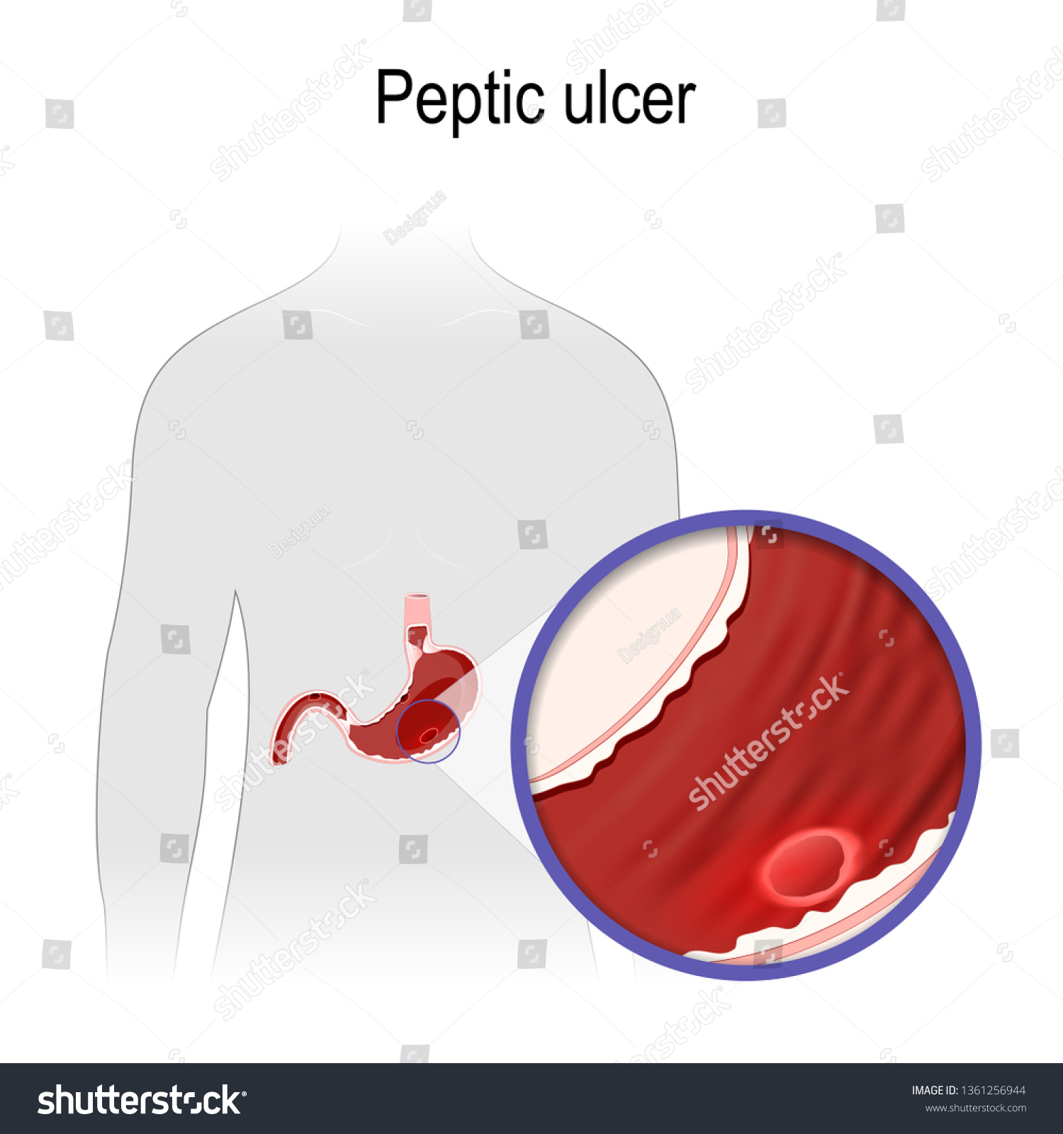 Peptic Ulcer Human Silhouette Close Stomach Stock Illustration ...