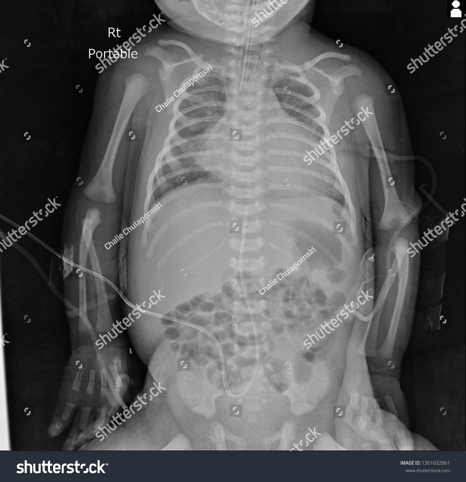 Chest Include Abdomen Xray Newborn Who Stock Photo 1361632661 ...