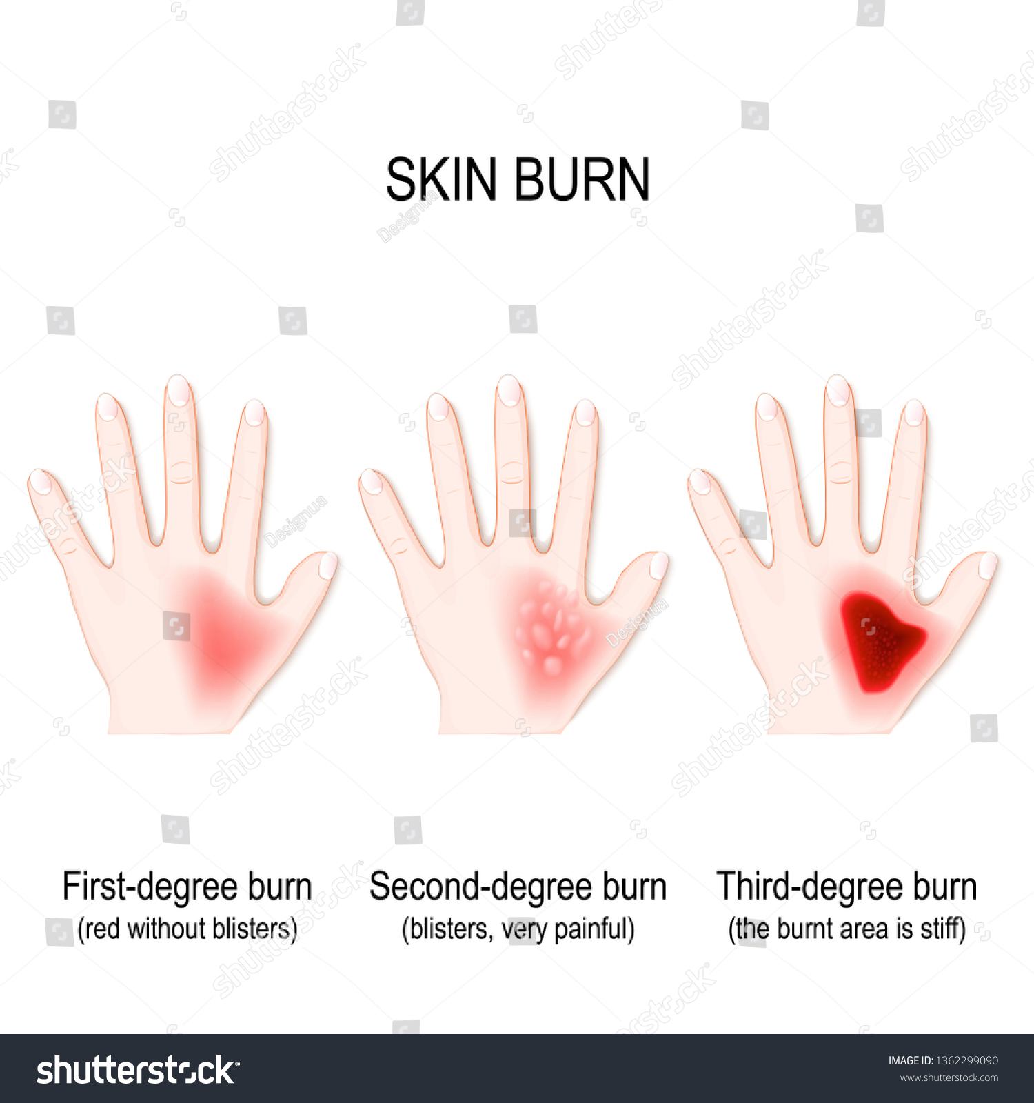 Degree Burns Skin Step Burn Human Stock Illustration 1362299090 ...