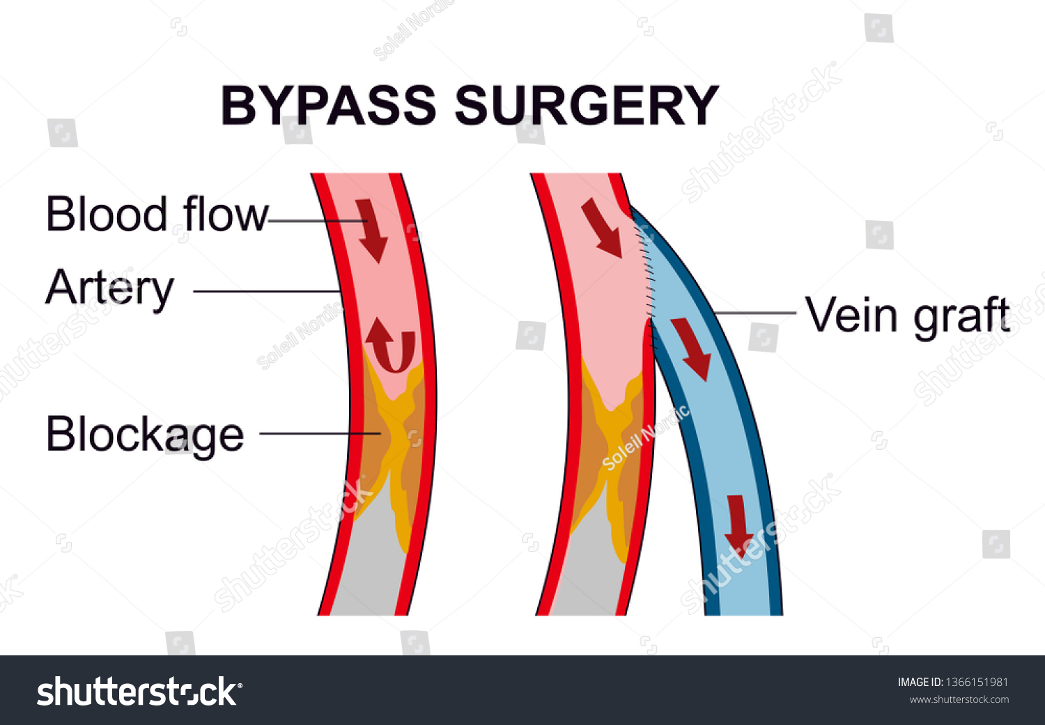 vascular-bypass-surgery-routes-blood-flow-stock-illustration-1366151981