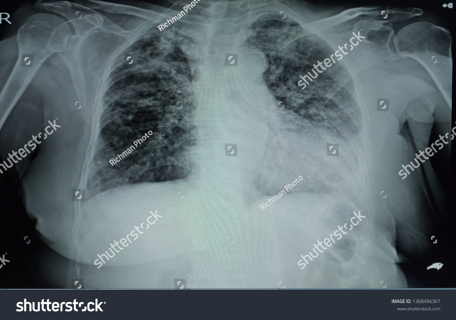 Chest Xray Female 78 Year Old Stock Photo 1368496367 | Shutterstock