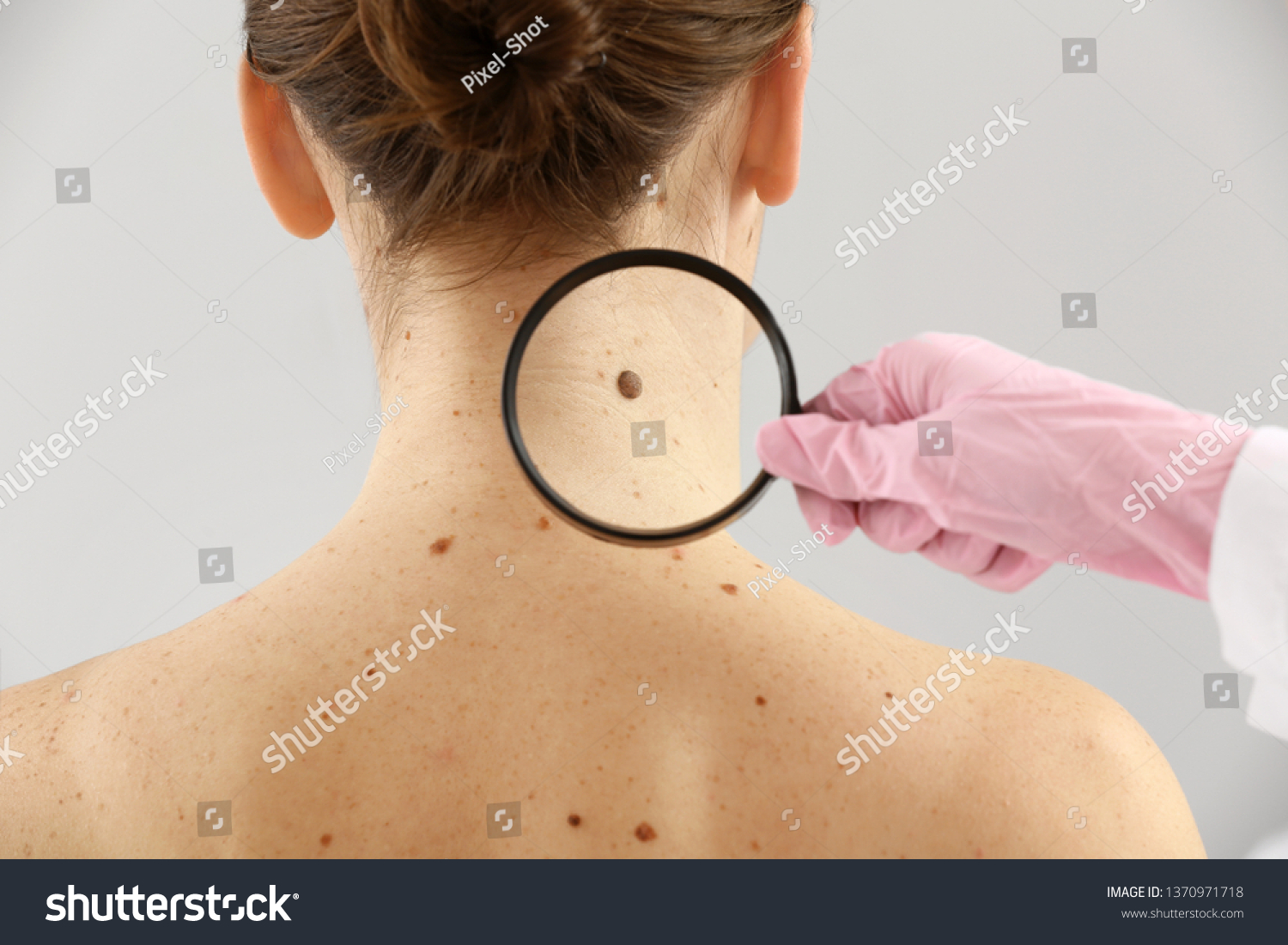 Dermatologist Examining Moles Patient On Light Stock Photo 1370971718 Dermatologist Examining Moles Patient On Light Stock Photo 1370971718