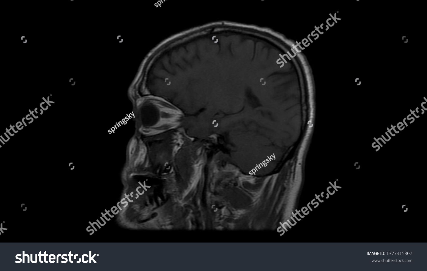 Brain Mri Scan Magnetic Resonance High Stock Photo 1377415307 ...