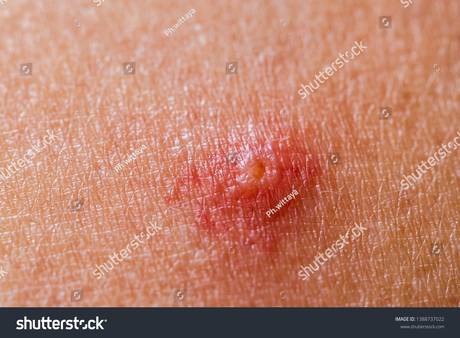 wound-infection-on-skin-skin-lesions-stock-photo-1388737022-shutterstock