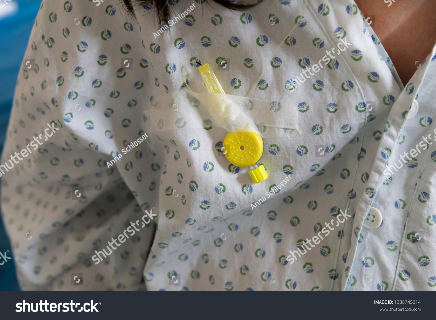 Detail Closeup Catheter Epidural Analgesic Medication Stock Photo