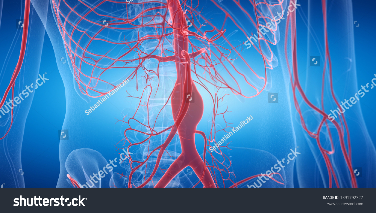 3d Rendered Medically Accurate Illustration Aneurysm Stock Illustration ...