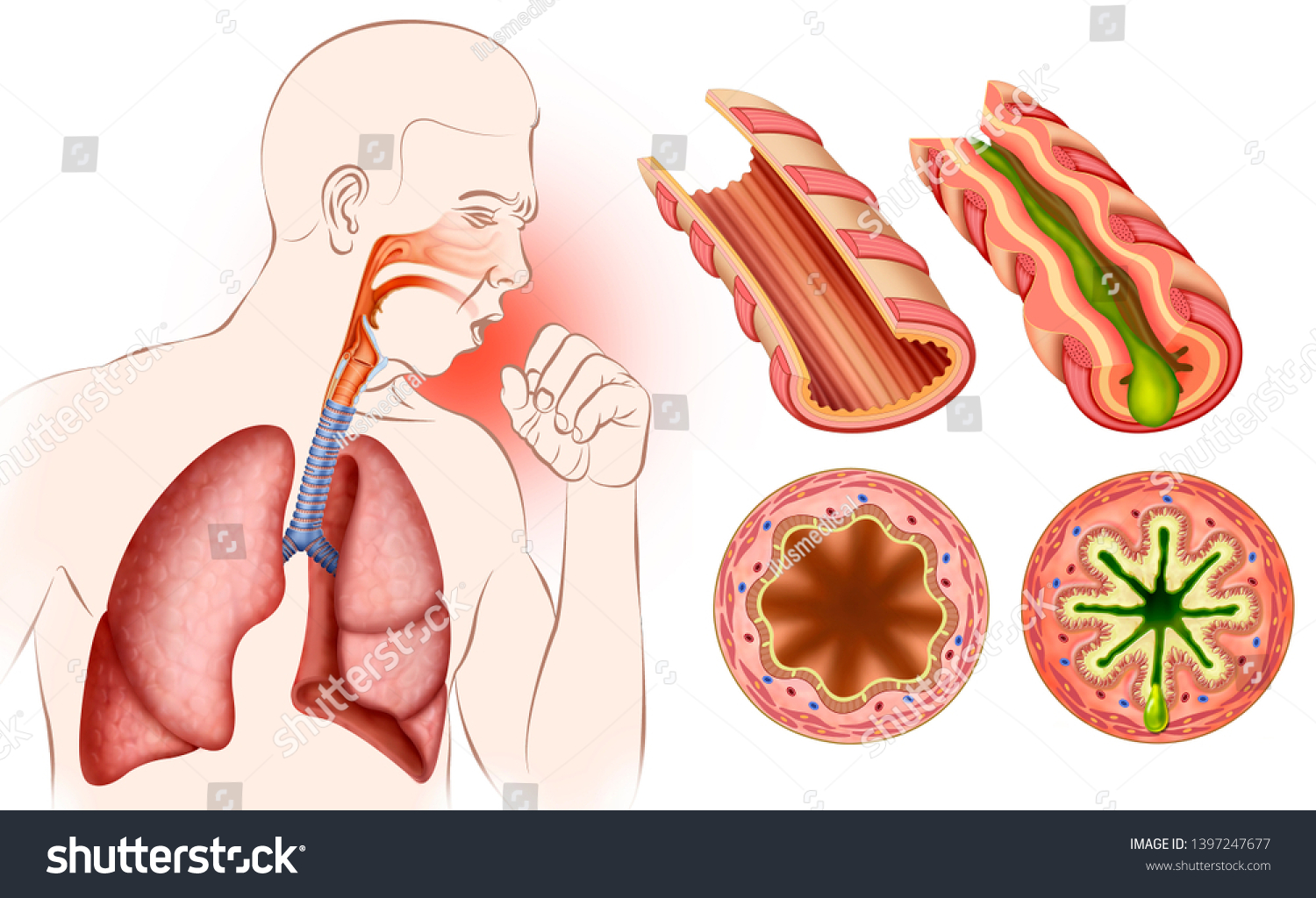 Как изобразить астму