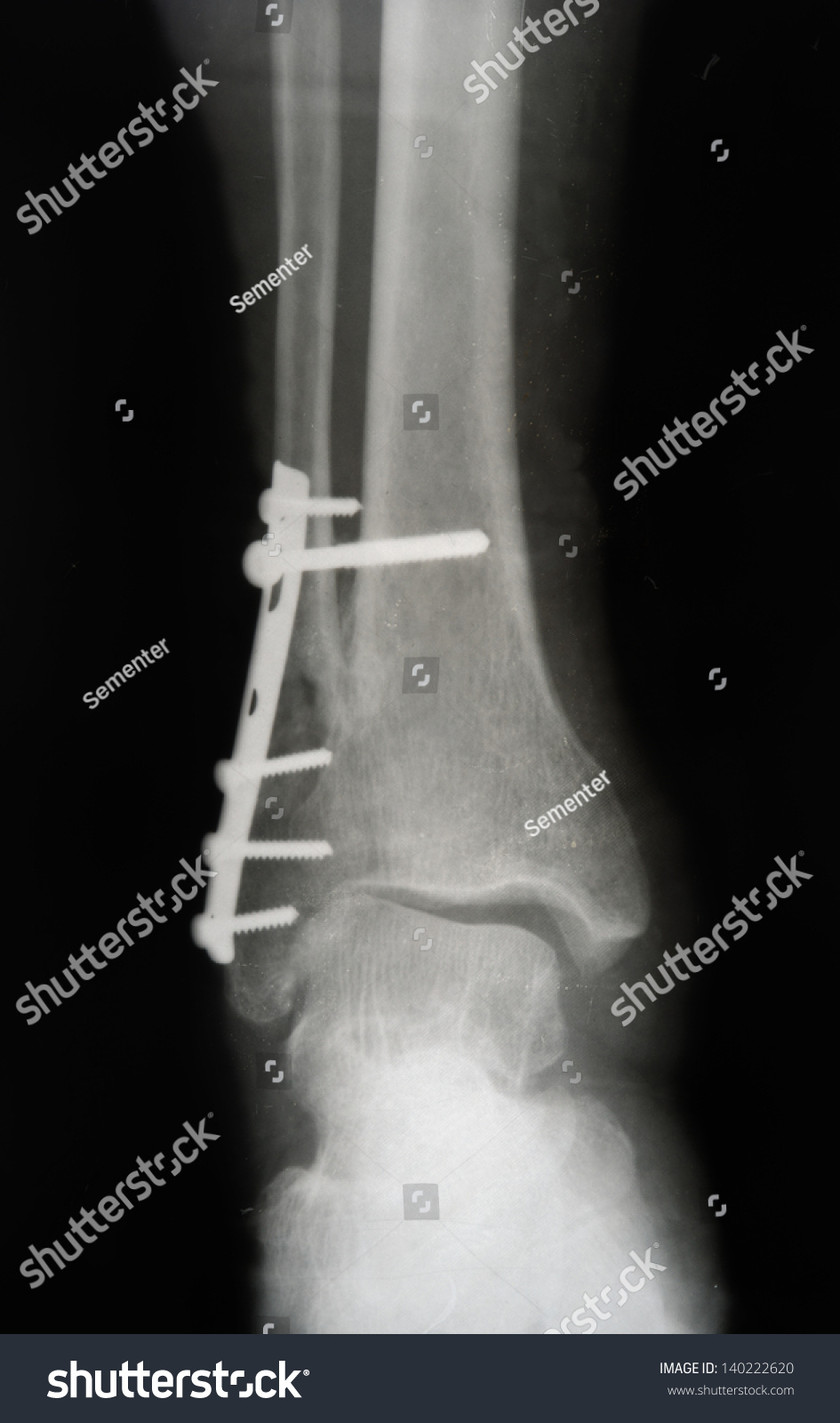 Fracture Lower Part Fibula Front View Stock Photo 140222620 | Shutterstock