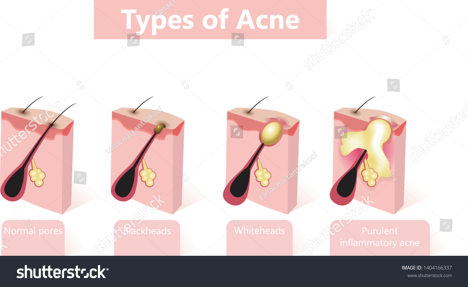 Types Acne Pimples Healthy Skin Whiteheads Stock Vector (Royalty Free ...