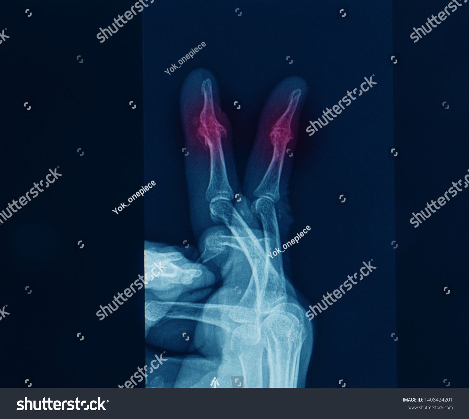 Lateral Projection Xray Finger Showing Arthritis Stock Photo 1408424201 ...