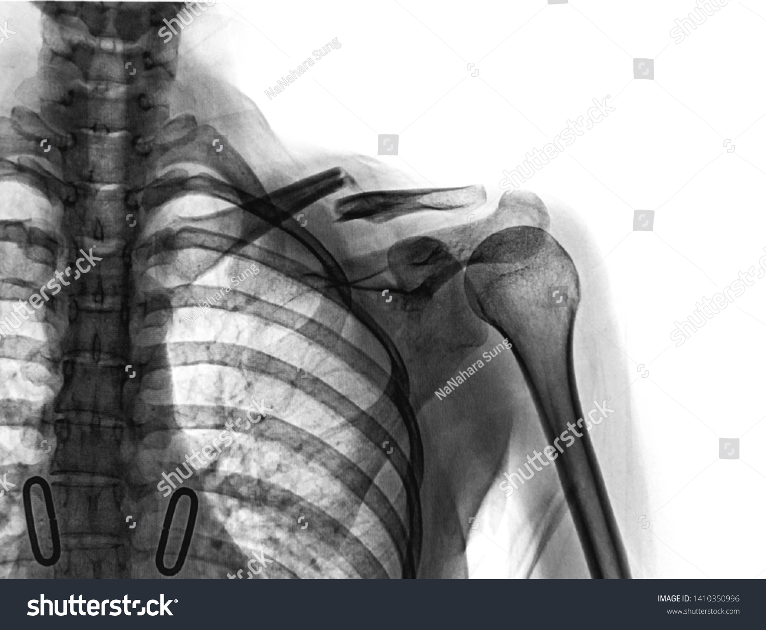 Xray Shoulder Joint Show Fracture Clavicle Stock Photo Shutterstock