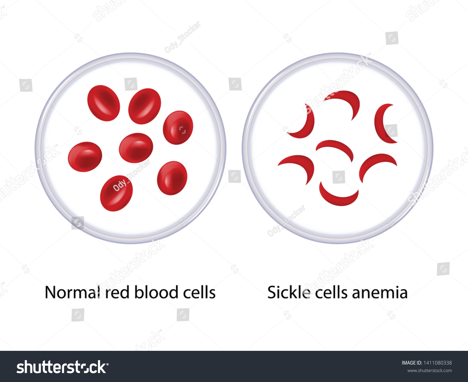 Normal Red Blood Cells Sickle Cells Stock Vector (Royalty Free ...