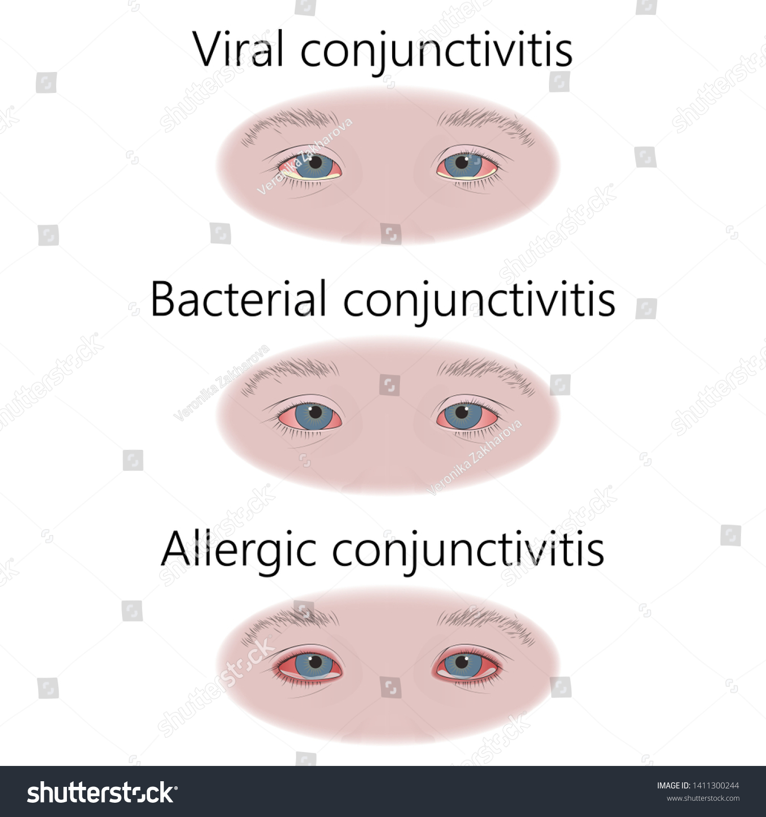 Types Conjunctivitis Allergic Allergy Viral Virus Stock Illustration ...